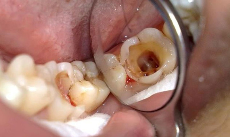Sâu răng vào tuỷ có nguy hiểm không, cách điều trị từ bác sĩ nha khoa khuyên bạn