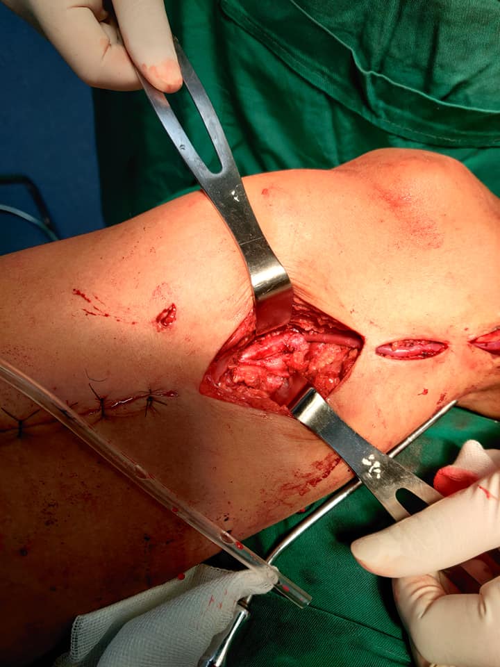 Phẫu thuật tái tưới máu bàn chân cho bệnh nhân tổn thương nặng mạch máu vùng cẳng bàn chân bởi hội chứng Buerger