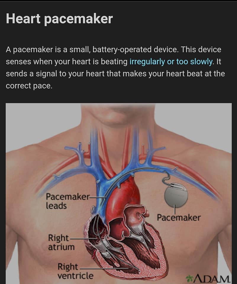 Khi nào cần đặt máy tạo nhịp tim?