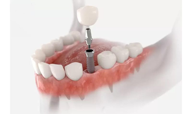 Trồng răng Implant giá rẻ: giải pháp tiết kiệm hay rủi ro?