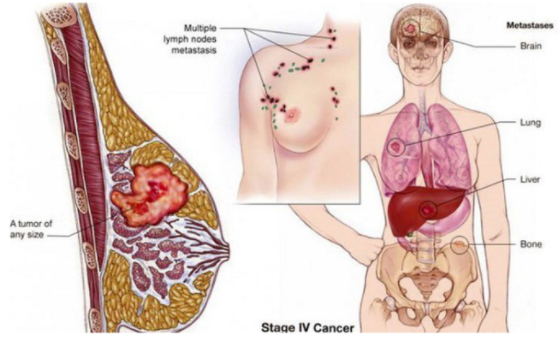 Ung thư gan và Biểu hiện dễ thấy 