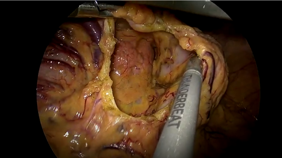  Phẫu thuật cắt thân đuôi tụy nội soi bảo tồn lách cho bệnh nhân u nhày đuôi tụy 
