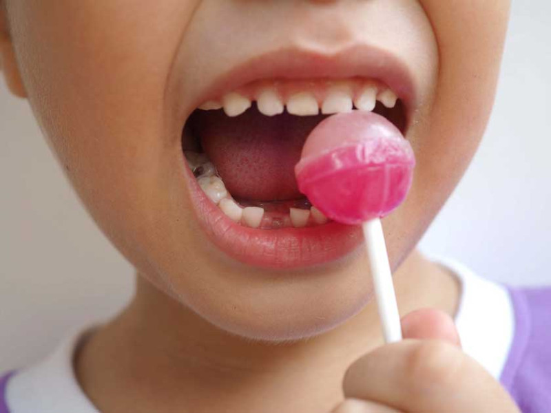 Sâu răng sữa vào tủy ở trẻ em: Nỗi lo của cha mẹ và cách giải quyết hiệu quả