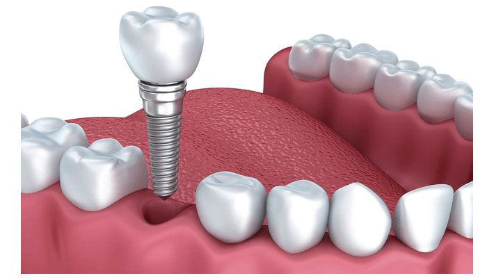 Lời khuyên về tư Vấn Trồng Răng Implant cho Người Già Qua Mạng Internet