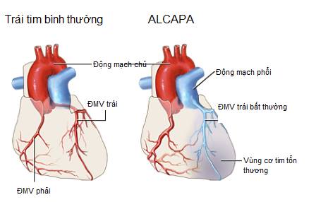ALCAPA  : Bất thường xuất phát của động mạch vành trái từ động mạch phổi