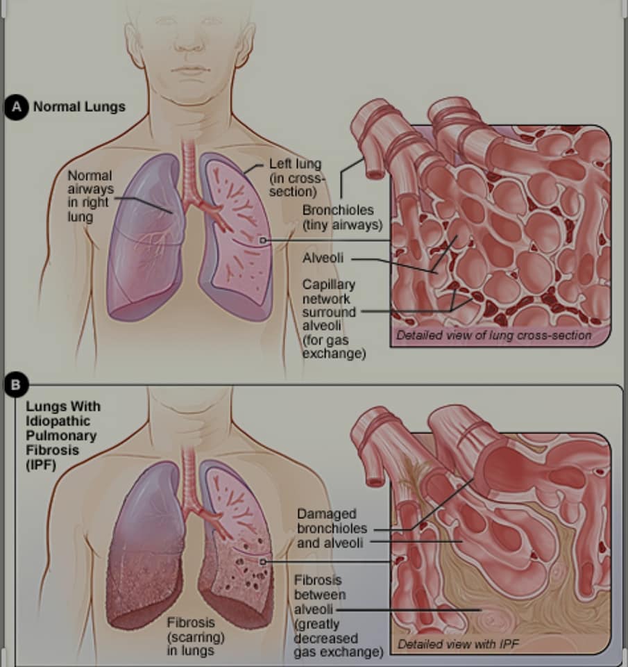 Toàn bộ về ung thư phổi