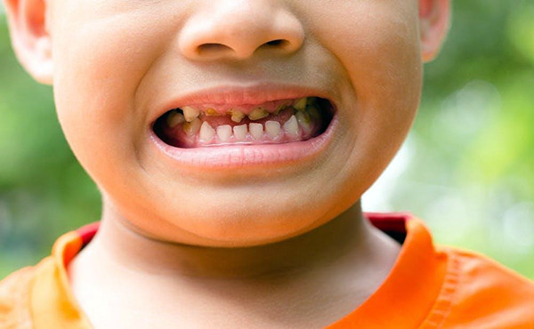 Hàm răng đen ở trẻ nhỏ: "Nỗi ám ảnh" của cha mẹ và cách giải quyết hiệu quả