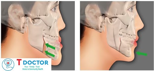 Có thể tập luyện và vận động bình thường khi xương hàm dưới đang trong quá trình lành?
