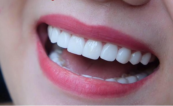 Hôi miệng sau làm răng sứ: Nỗi ám ảnh và cách giải quyết hiệu quả