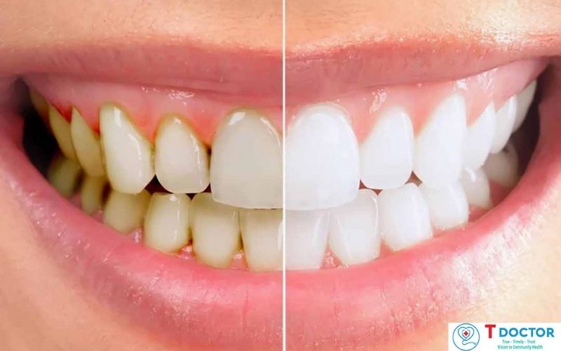 Lấy cao răng để loại bỏ hàng tá vi khuẩn khỏi răng miệng