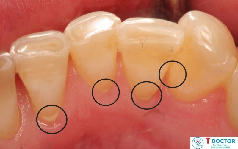 Cao răng hình thành tại nướu và chân răng
